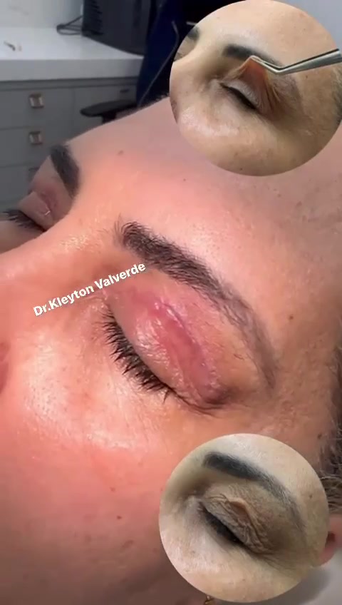 Procedimento definitivo